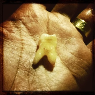 2011-02-21 tooth pulled