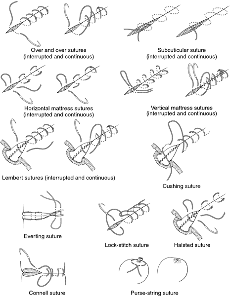 suture